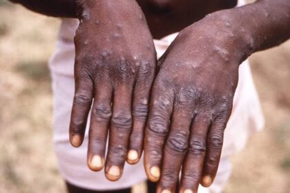 Mpox Outbreak: Uganda Records 2 Imported Cases