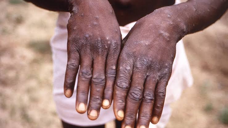 Mpox Outbreak: Uganda Records 2 Imported Cases